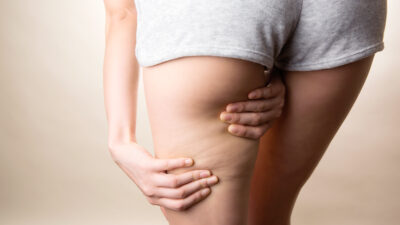 セルライトを除去するダイエットを行う際の水分の役割とは？